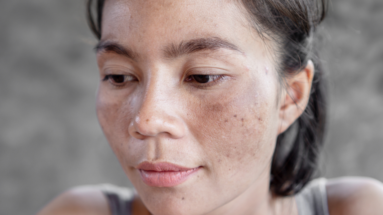 Hyperpigmentation Treatment